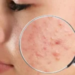 Dəri törəmələrinin müayinə və müalicəsi deri toremeleri