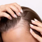 SAÇ və Dırnaq xəstəlikləri